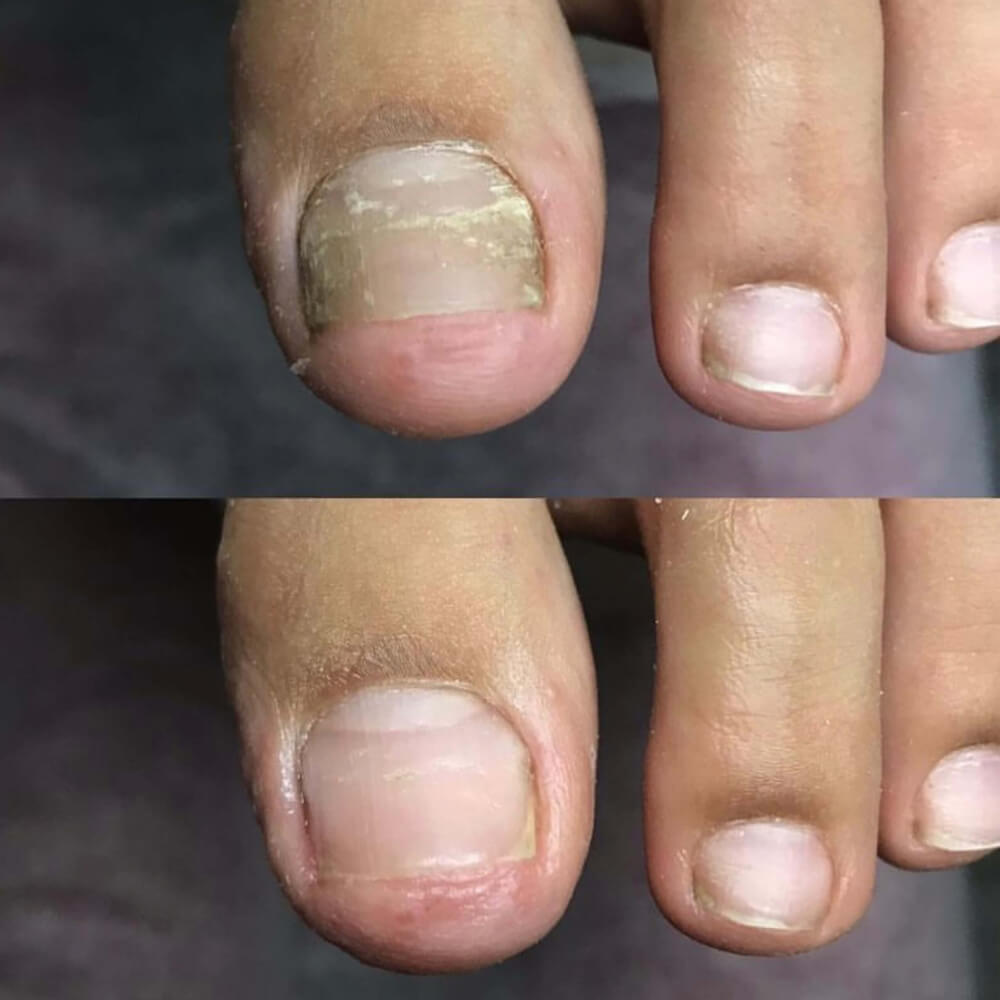 Nail Fungus Skötsel Pen