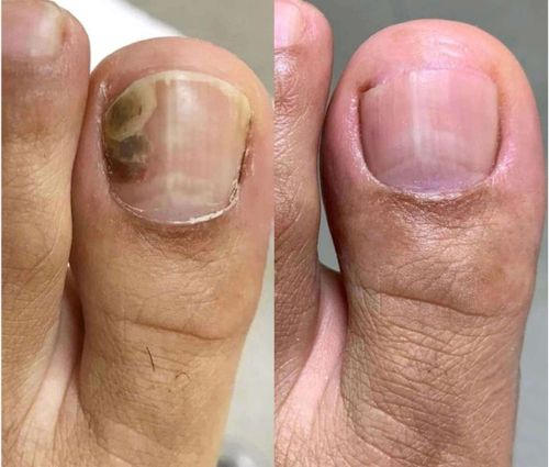 Nail Fungus Skötsel Pen
