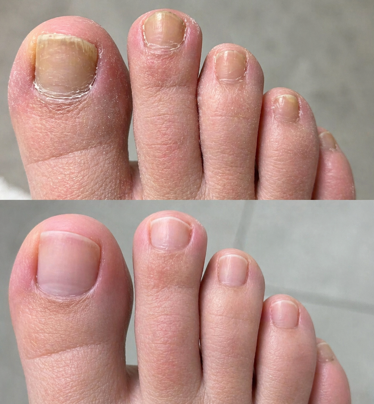 Nail Fungus Skötsel Pen