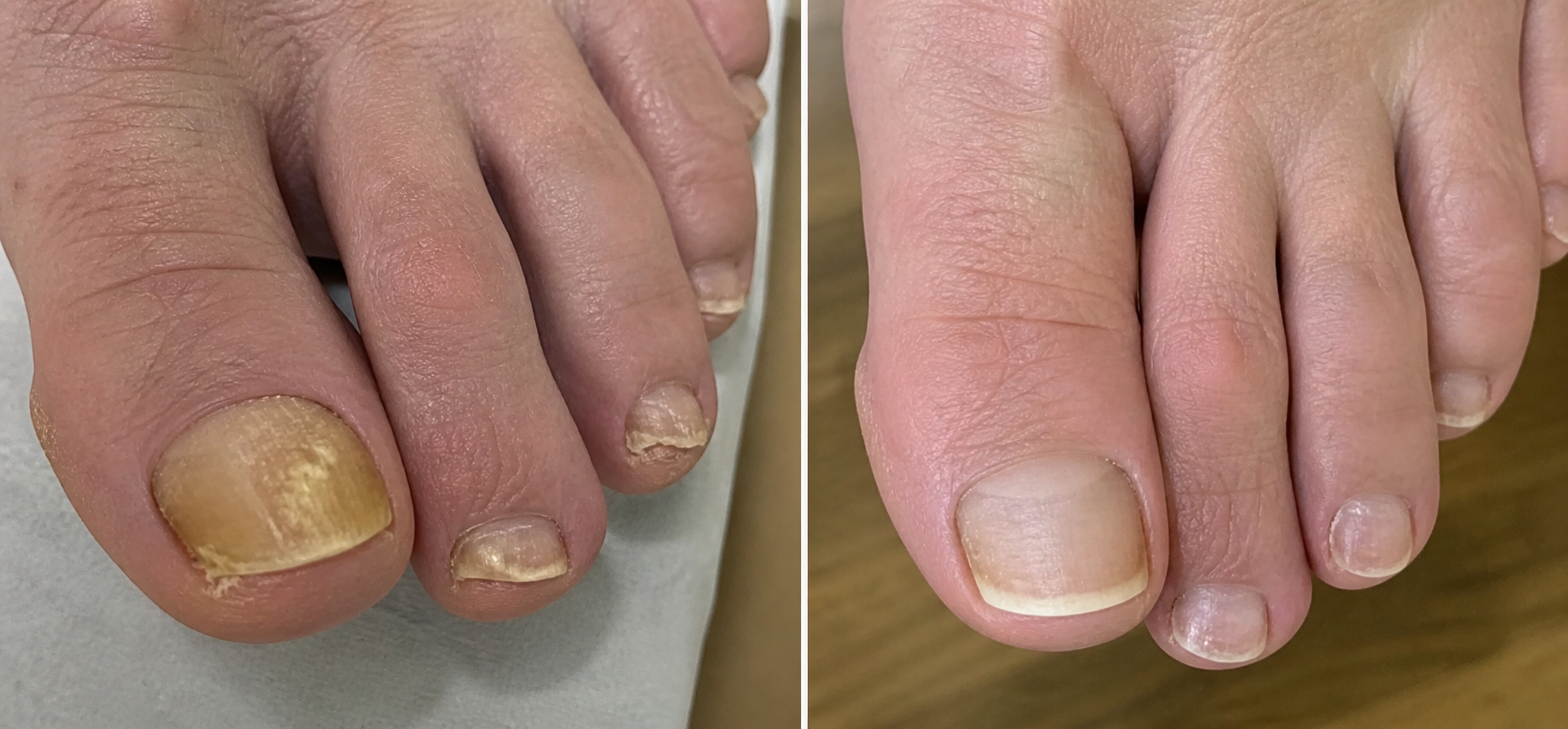 Nail Fungus Skötsel Pen