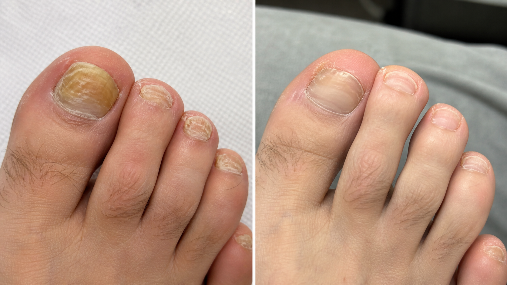 Nail Fungus Skötsel Pen