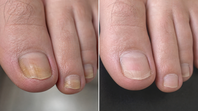Nail Fungus Skötsel Pen