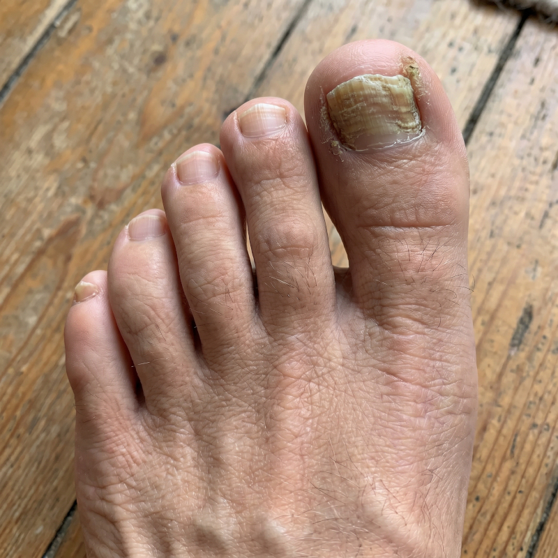 Nail Fungus Skötsel Pen
